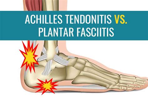 It is common among athletes who run and jump a lot. . Difference between plantar fasciitis and achilles tendonitis